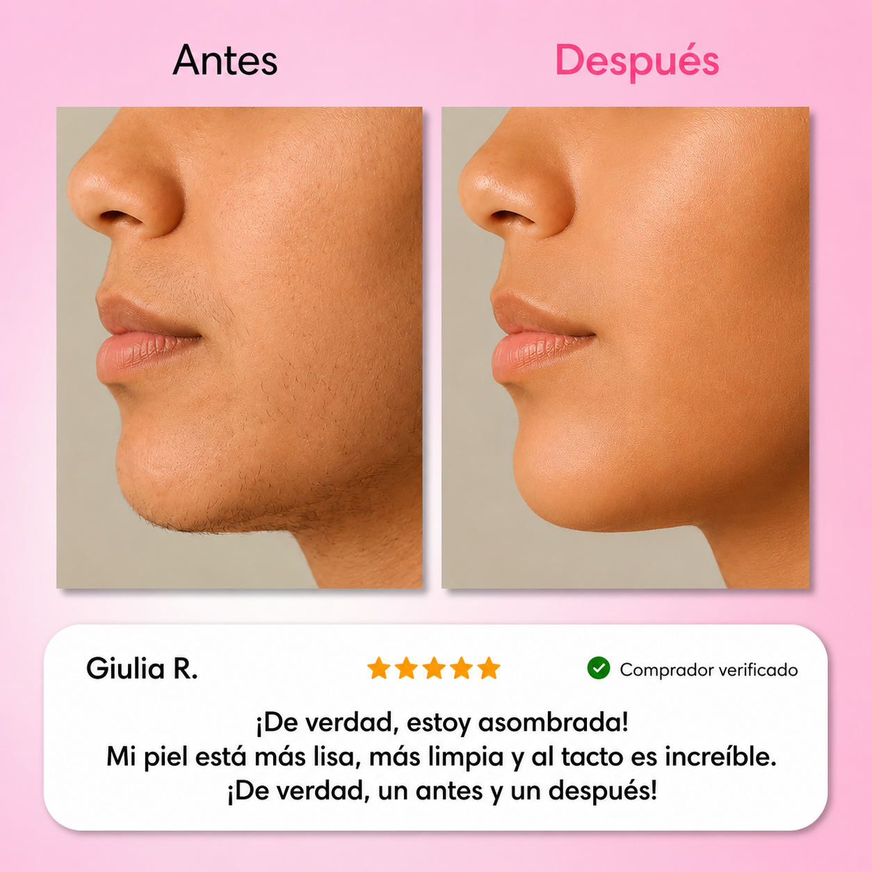 El primer kit completo de 3 fases que debilita y disuelve el vello hormonal sin dolor ni irritaciones